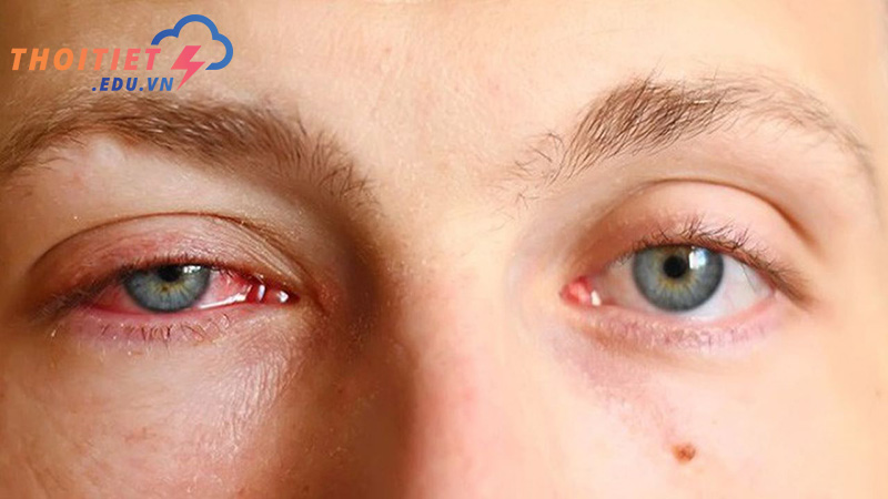 Khi tiếp xúc dưới nắng quá lâu, tác hại của tia UV có thể làm tổn thương mắt